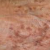 Age spots