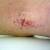 dermatitis legs