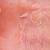 images and pictures of dyshidrotic eczema