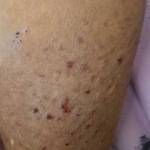home remedies for discoid eczema